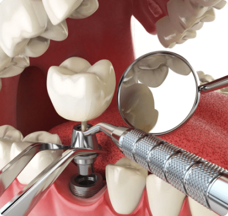 new dental implants