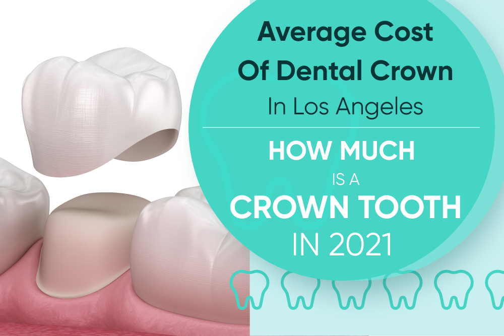 Average Cost Of Dental Crown In Los Angeles - How Much Is A Crown Tooth In 2021