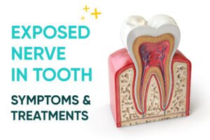 Exposed Nerve in Tooth: Symptoms & Treatments - NoHo Family Dental