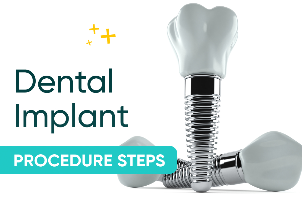 Dental Implant Procedure Steps