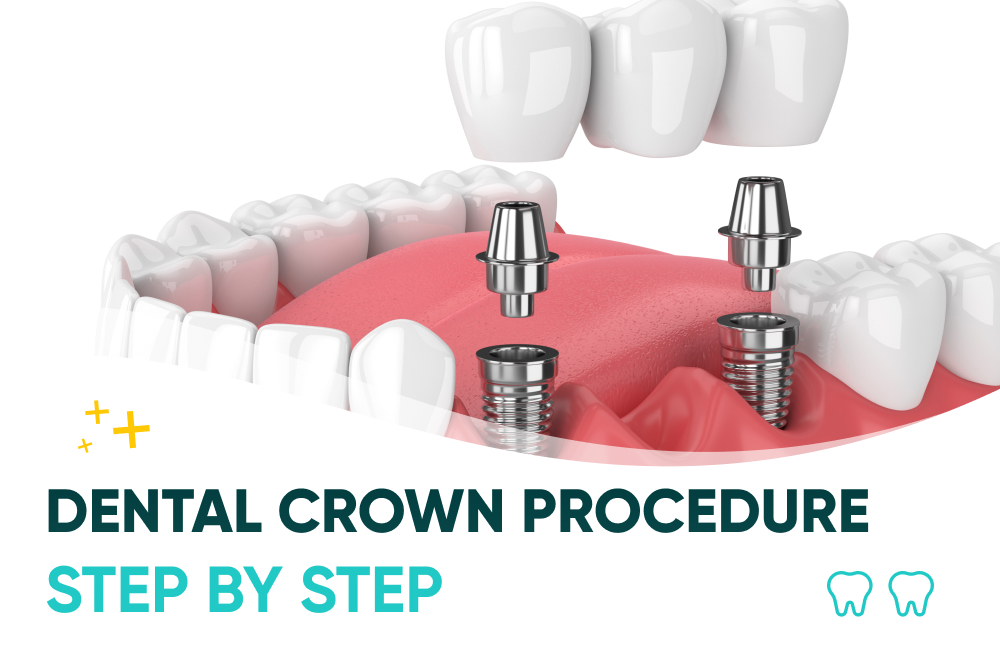 Dental crown procedure
